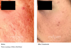 MDPen_BeforeAfter_011419_acne_v01