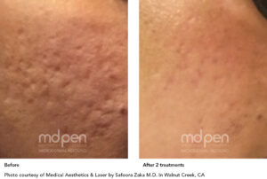 MDPen_BeforeAfter_011419_acne_v02