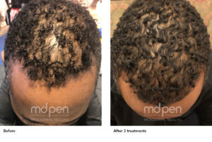 MDPen_BeforeAfter_022620_hair